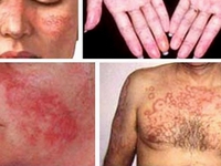 Chữa lupus ban đỏ, cần lưu ý độc tính của thuốc