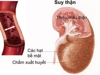 Suy thận nhẹ, dùng thuốc thế nào?