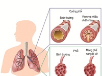 Người nghiện thuốc lá: Khó tránh khỏi bệnh phổi tắc nghẽn mãn tính