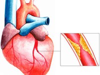 Gắng sức về trí óc và thể lực, kẻ đồng hành gây bệnh tim