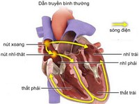 Rối loạn chức năng nút xoang, trị thế nào?