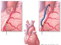 Ai cần phẫu thuật bắc cầu nối động mạch vành?