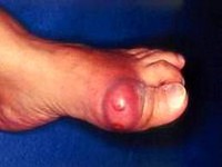 Khớp ngón chân cái sưng đỏ, đề phòng bệnh gút