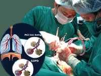 Ðột phá trong điều trị bệnh phổi tắc nghẽn mạn tính