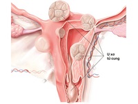 U xơ tử cung và đậu nành