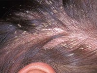 Chọn thuốc điều trị viêm da dầu hiệu quả