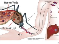 Một bệnh nhi sốc sốt xuất huyết biến chứng xuất huyết nặng được cứu sống