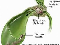 Điều trị sỏi túi mật