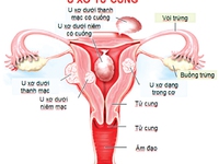 U xơ tử cung có nguy hiểm?