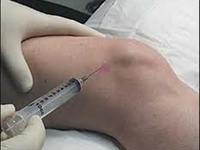 Tiêm vào khớp - Ai nên, ai không?