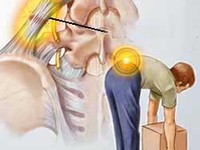 Sửa sai tư thế để tránh thoát vị đĩa đệm