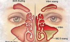 Cách tự chăm sóc sau mổ mũi xoang và phát hiện biến chứng 