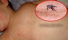 Cảnh giác với biến chứng của bệnh sốt xuất huyết Dengue 