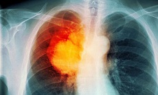 Mắc ung thư phổi: Tiên lượng sống và điều trị thế nào?