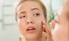 Da nứt nẻ mùa hanh khô phải làm sao?