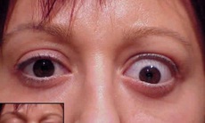 Liệu pháp mới trị ‘lồi mắt’ do cường giáp