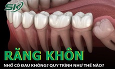 Răng khôn nguy hiểm như thế nào? Tại sao cần phải nhổ răng khôn?