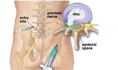 Người mắc bệnh lý về cột sống, khi nào cần tiêm giảm đau steroid ngoài màng cứng tủy?