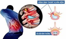 Tìm hiểu nguyên nhân và cách nhận biết bệnh thoát vị đĩa đệm