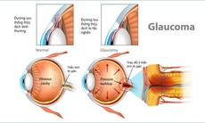 Glaucoma - 'Kẻ đánh cắp' thị giác thầm lặng