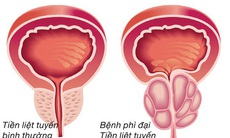 Những biến chứng nguy hiểm của tăng sinh lành tính tiền liệt tuyến