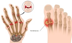 Bệnh gout ngày càng trẻ hóa, cần làm gì để "sống chung với gout"?