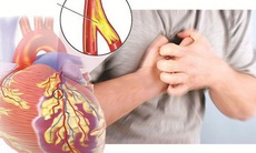 Bệnh động mạch vành và các yếu tố nguy cơ