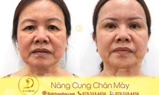 Nâng cung chân mày đẹp, trẻ trung ở bác sĩ giỏi