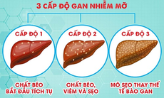 Gan nhiễm mỡ cấp độ 1, 2 - có thể chữa khỏi?