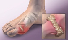 Trị gout bằng y học cổ truyền như thế nào?