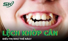 Lệch khớp cắn chữa trị như thế nào?