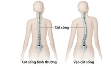 Cong vẹo cột sống ở trẻ - Nhận biết, nguyên nhân và điều trị