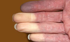 Hội chứng Raynaud là gì, chữa thế nào?