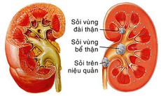 Bài thuốc phòng và trị sỏi đường tiết niệu