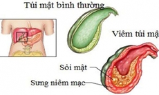 Day ấn huyệt hỗ trợ trị viêm túi mật