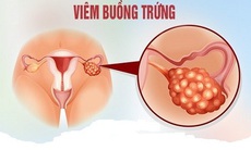 Tại sao buồng trứng bị viêm?