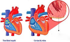 Cảnh giác với bệnh viêm cơ tim ở trẻ