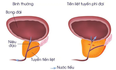 Phì đại tiền liệt tuyến: Nguyên nhân, triệu chứng và cách xử lý