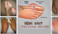 Thực phẩm - thuốc tốt cho người bệnh gút 