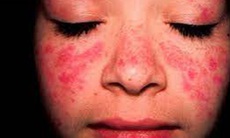 Người bệnh Lupus ban đỏ đã có thêm một lựa chọn điều trị mới