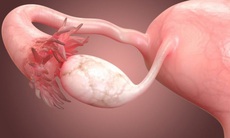 Suy buồng trứng sớm - Các triệu chứng, nguyên nhân và cách điều trị