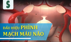Túi phình động mạch não - "Quả bom" chờ nổ