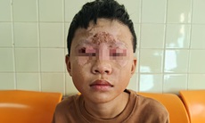 Tự chế pháo nổ theo mạng xã hội, bé 10 tuổi bị bỏng vùng mặt thương tâm