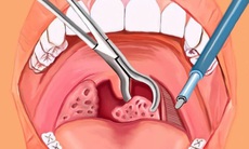 Cắt amidan: Chuyên gia nhấn mạnh những vấn đề cần lưu ý