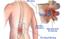 Bài tập phòng ngừa và phục hồi hội chứng đau thắt lưng