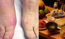 Chớ nên tăng liều thuốc để dự phòng cơn gout cấp