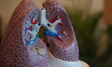 Liệu pháp trị viêm phổi không cần dùng kháng sinh