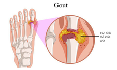 Allopurinol không làm tăng nguy cơ tử vong ở người bệnh gout có vấn đề về thận mãn tính