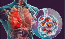 Biện pháp hỗ trợ giảm triệu chứng viêm phổi khi trời trở lạnh tại nhà