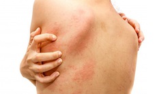 Nguyên nhân gây phát ban đỏ trên da và cách khắc phục